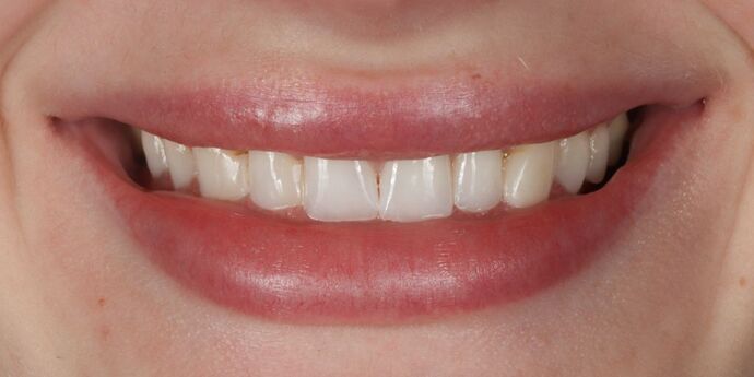 No-Prep Veneers: Taylor - Before