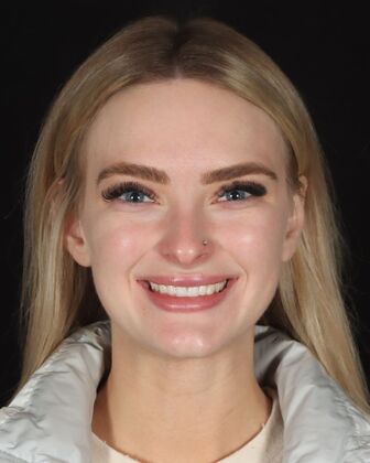 No-Prep Veneers Taylor - Before