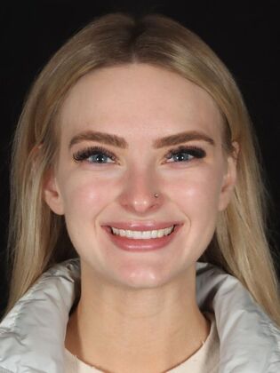 No-Prep Veneers Taylor - Before