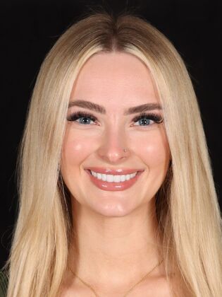 No-Prep Veneers Taylor - After