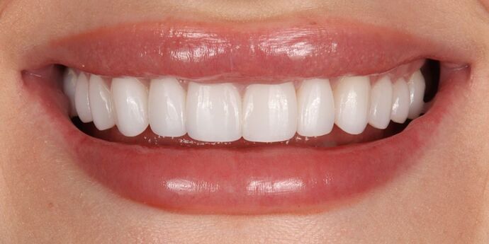 No-Prep Veneers: Taylor - After