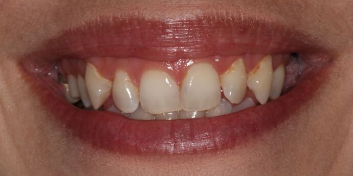 Full Mouth Reconstruction: Amy - Before