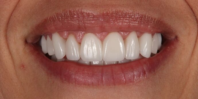 Full Mouth Reconstruction: Amy - After