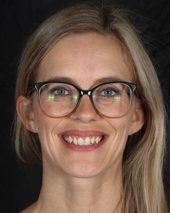 Full Mouth Reconstruction Amy - Before