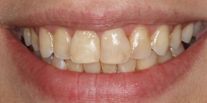 Full Mouth Reconstruction: Ariel - Before