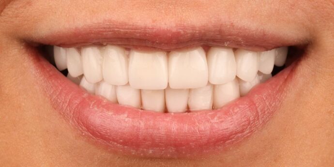 Full Mouth Reconstruction: Ariel - After