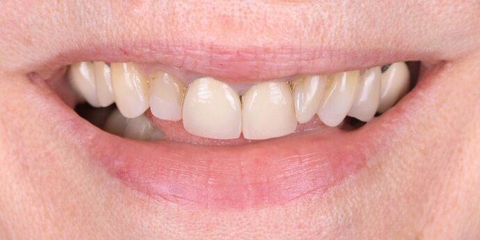 Full Mouth Reconstruction: Barb - Before