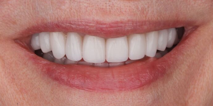 Full Mouth Reconstruction: Barb - After