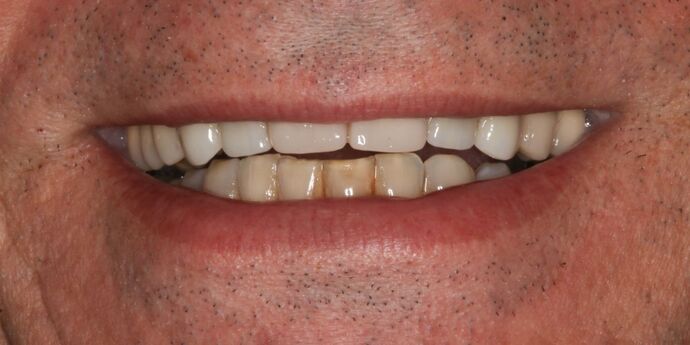 Full Mouth Reconstruction: Charles - Before