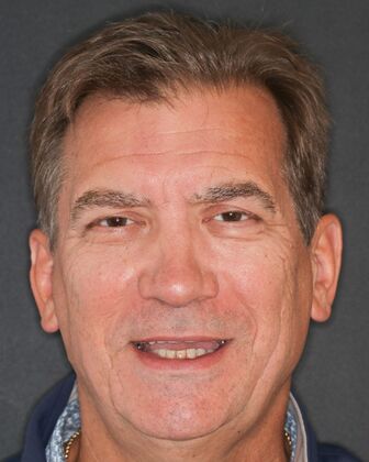 Full Mouth Reconstruction Charles - Before