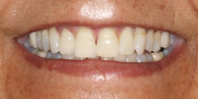 Full Mouth Reconstruction: Edna - Before