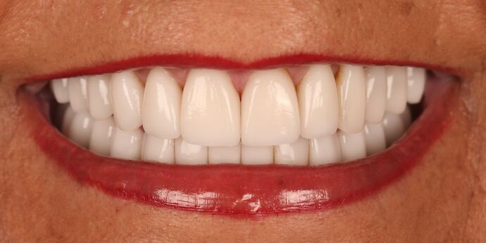 Full Mouth Reconstruction: Edna - After