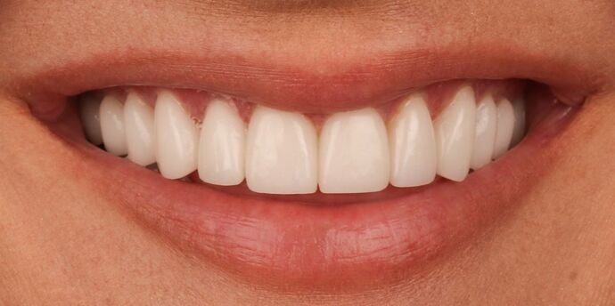 Full Mouth Reconstruction: Jasmina - After