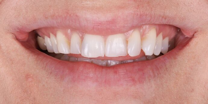 Full Mouth Reconstruction: Jasmina - Before