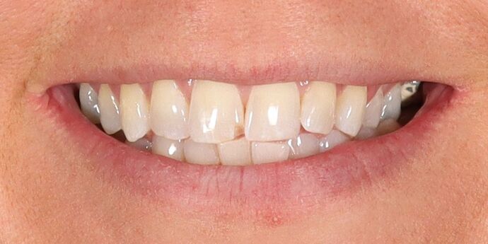 Full Mouth Reconstruction: Jen - Before