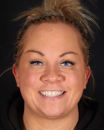 Full Mouth Reconstruction Jen - Before