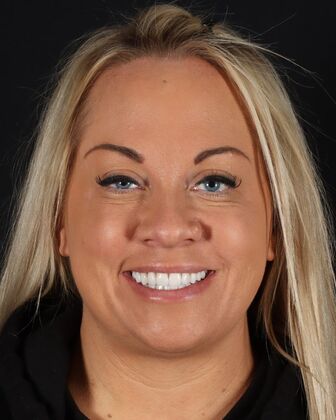 Full Mouth Reconstruction Jen - After