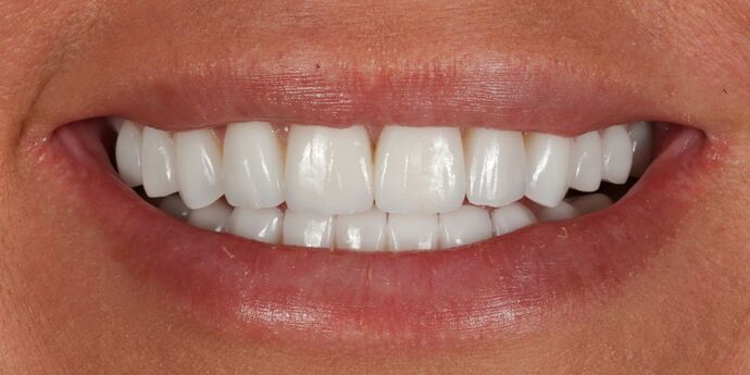 Full Mouth Reconstruction: Jen - After