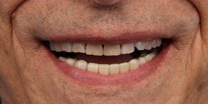 Full Mouth Reconstruction: John B. - Before