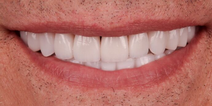 Full Mouth Reconstruction: John B. - After