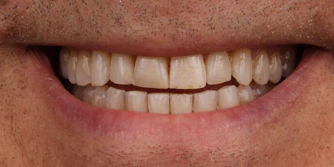 Full Mouth Reconstruction: John S. - Before