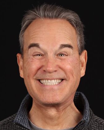 Full Mouth Reconstruction John S. - Before