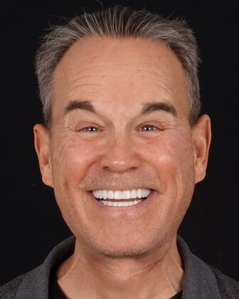 Full Mouth Reconstruction John S. - After