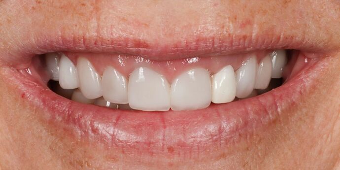 Full Mouth Reconstruction: Kerrin - Before