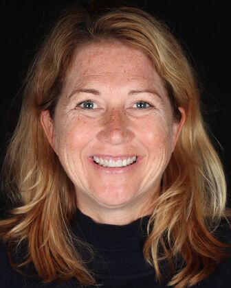 Full Mouth Reconstruction Kerrin - Before