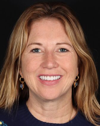 Full Mouth Reconstruction Kerrin - After