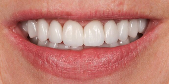 Full Mouth Reconstruction: Kerrin - After