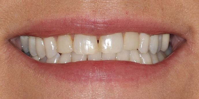 Full Mouth Reconstruction: Mary - Before