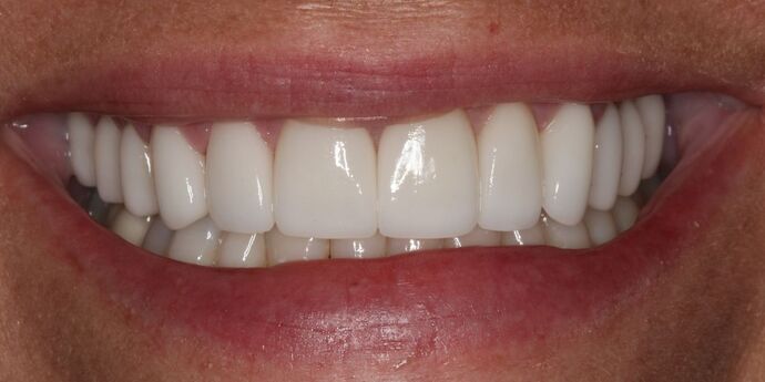 Full Mouth Reconstruction: Mary - After