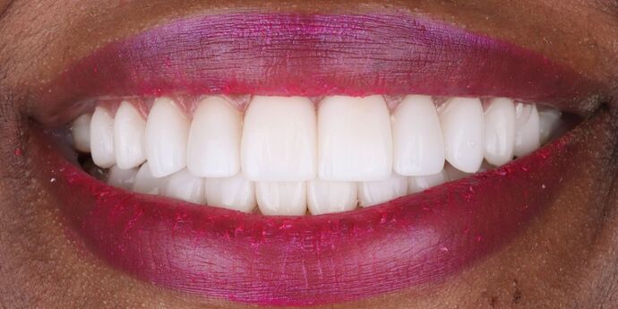 Full Mouth Reconstruction: Melissa A. - After