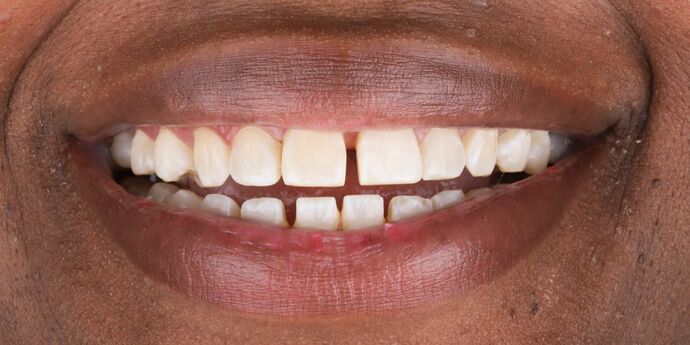 Full Mouth Reconstruction: Melissa A. - Before