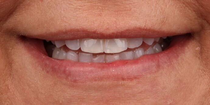 Full Mouth Reconstruction: Melissa G. - Before