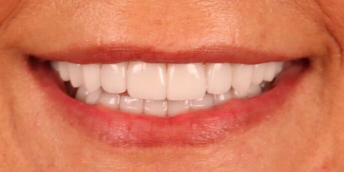 Full Mouth Reconstruction: Melissa G. - After