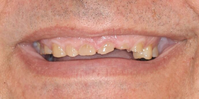 Full Mouth Reconstruction: Orin - Before