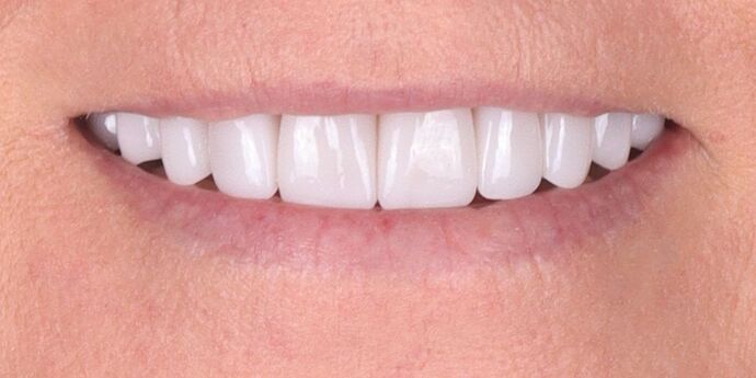 Full Mouth Reconstruction: Susan - After