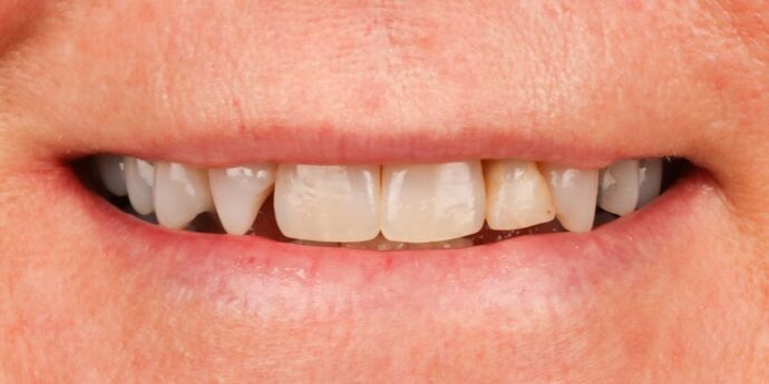 Full Mouth Reconstruction: Susan - Before