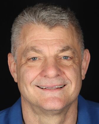 Full Mouth Reconstruction Tim - Before