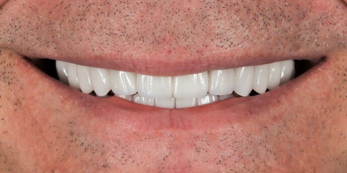 Full Mouth Reconstruction: Tim - After