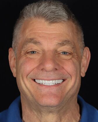 Full Mouth Reconstruction Tim - After