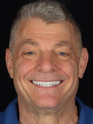 Full Mouth Reconstruction Tim - After
