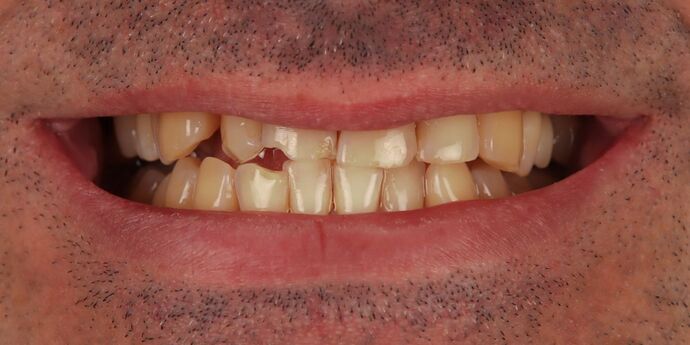 Full Mouth Reconstruction: Toli - Before