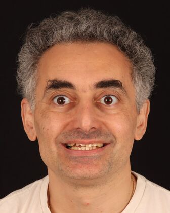 Full Mouth Reconstruction Toli - Before