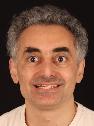 Full Mouth Reconstruction Toli - Before