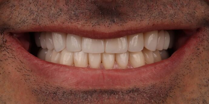 Full Mouth Reconstruction: Toli - After