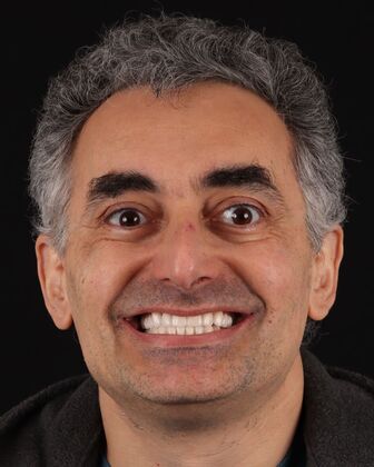 Full Mouth Reconstruction Toli - After