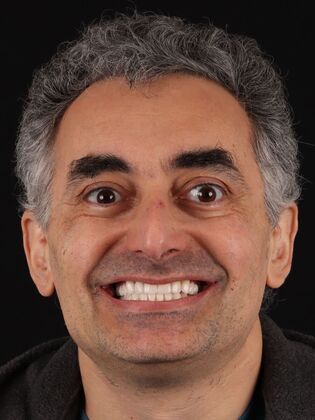 Full Mouth Reconstruction Toli - After